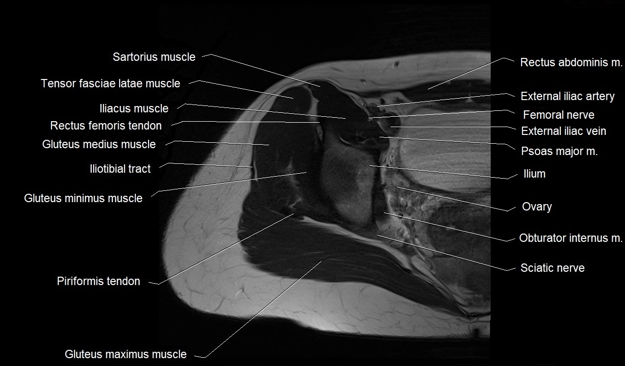 MRI thigh cross sectional anatomy image 4.webp